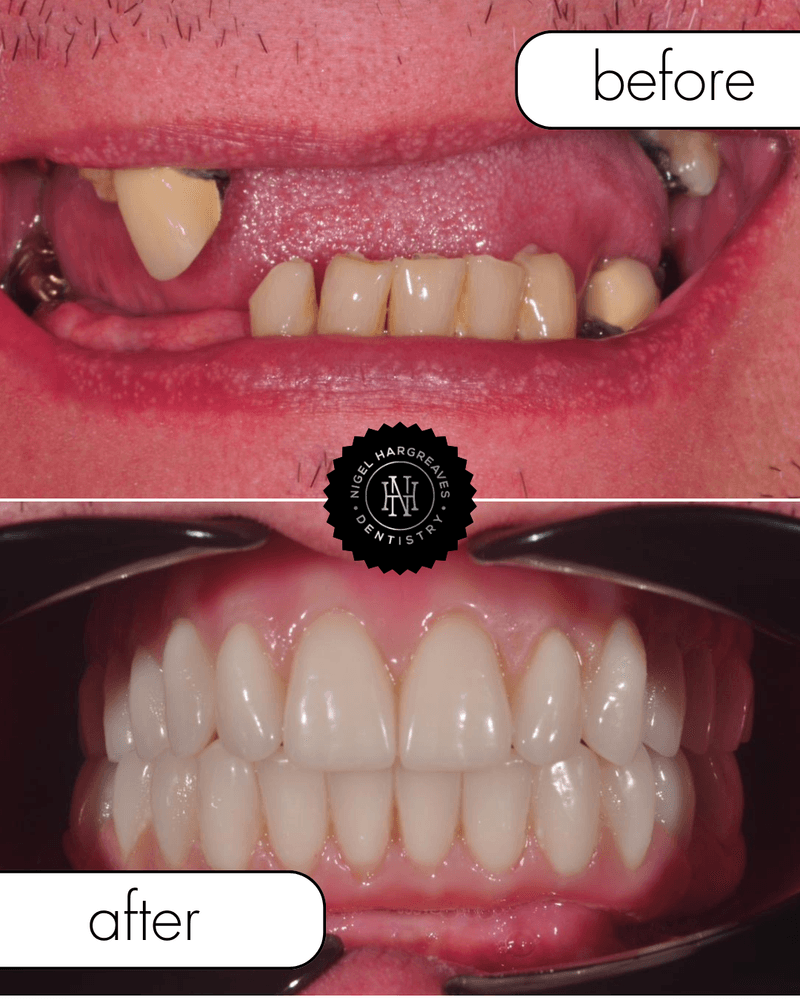 Patient result 4 — full mouth implant treatment by Dr Nigel Hargreaves