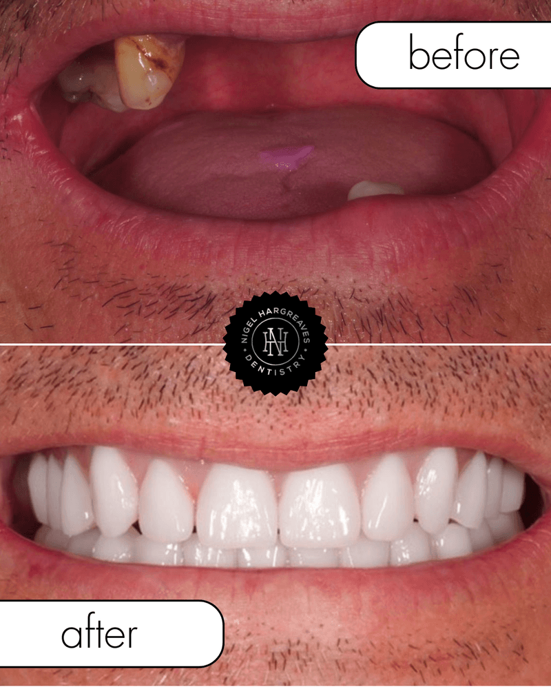 Patient result 3 — full mouth implant treatment by Dr Nigel Hargreaves