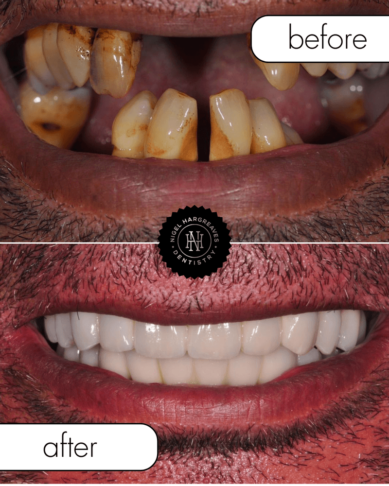Patient result 2 — full mouth implant treatment by Dr Nigel Hargreaves