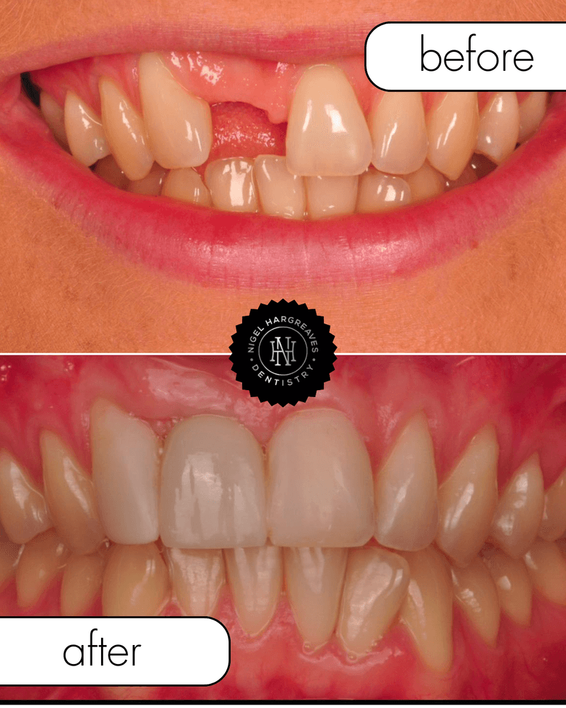 Patient result 1 — full mouth implant treatment by Dr Nigel Hargreaves